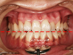 歯肉ホワイトニングの症例