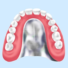 金属床（チタン床）義歯