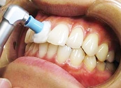虫歯の原因は3ヶ月ごとに除去しましょう